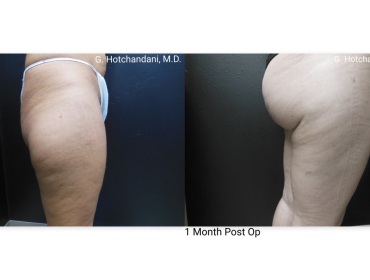 reNUplasty_vaserlipo_renuvion_before_and_after-59