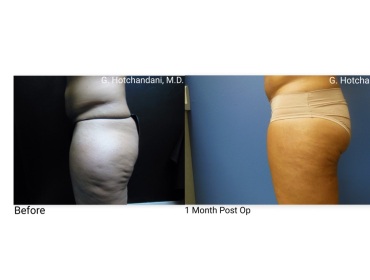 reNUplasty_vaserlipo_renuvion_before_and_after-60
