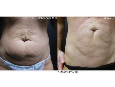 reNUplasty_vaserlipo_renuvion_before_and_after-61