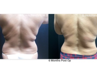 reNUplasty_vaserlipo_renuvion_before_and_after-62