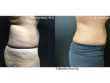 reNUplasty_vaserlipo_renuvion_before_and_after-63