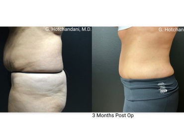 reNUplasty_vaserlipo_renuvion_before_and_after-64