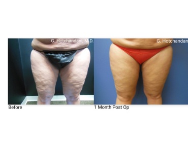 reNUplasty_vaserlipo_renuvion_before_and_after-7