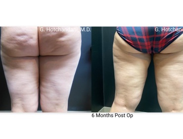 reNUplasty_vaserlipo_renuvion_before_and_after-8