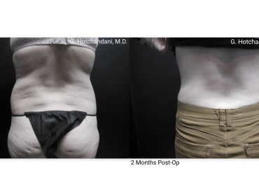 reNUplasty_vaserlipo_renuvion_before_and_after-9