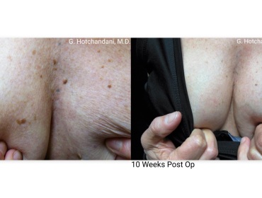 mole_removal_before_and_after-1