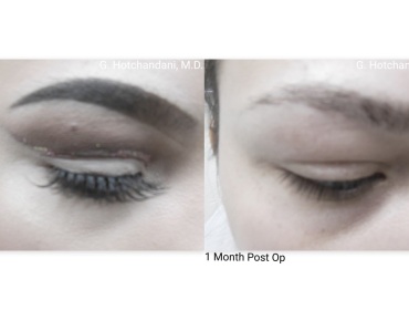 mole_removal_before_and_after-2