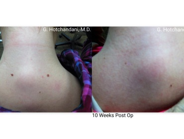 mole_removal_before_and_after-3