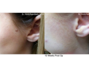 mole_removal_before_and_after-4