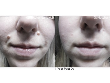 mole_removal_before_and_after-5