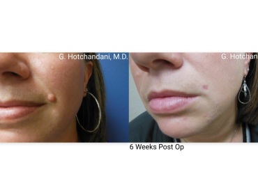 mole_removal_before_and_after-6