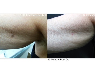 mole_removal_before_and_after-7