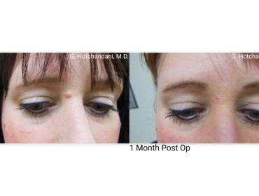 mole_removal_before_and_after-8