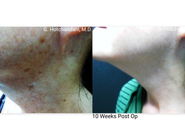 mole_removal_before_and_after-9