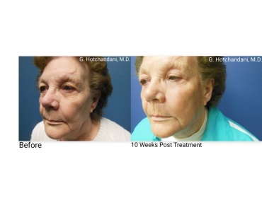 skin_rejuvenation_before_and_after-10