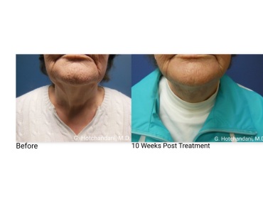 skin_rejuvenation_before_and_after-11