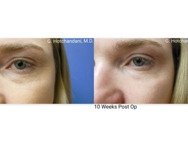 skin_rejuvenation_before_and_after-12