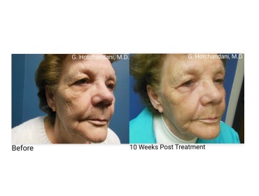 skin_rejuvenation_before_and_after-13