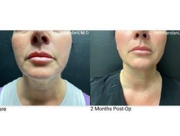 skin_rejuvenation_before_and_after-15