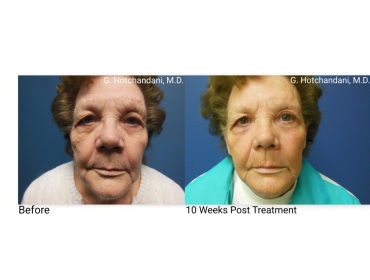 skin_rejuvenation_before_and_after-16