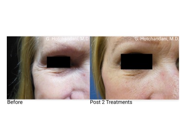 skin_rejuvenation_before_and_after-17