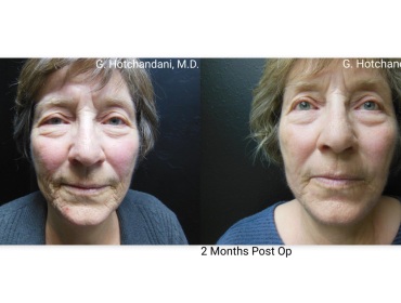 skin_rejuvenation_before_and_after-18