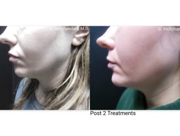 skin_rejuvenation_before_and_after-19