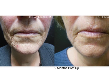 skin_rejuvenation_before_and_after-2