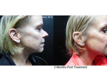 skin_rejuvenation_before_and_after-20