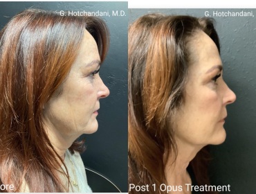 skin_rejuvenation_before_and_after-21