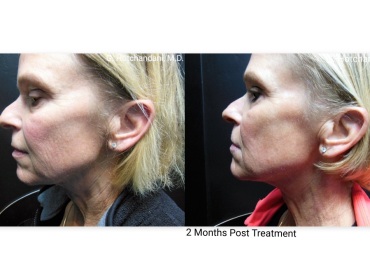 skin_rejuvenation_before_and_after-22