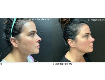 skin_rejuvenation_before_and_after-23