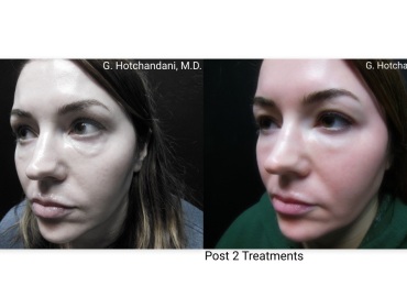 skin_rejuvenation_before_and_after-24