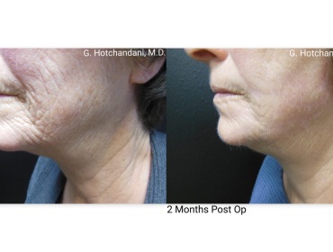 skin_rejuvenation_before_and_after-3