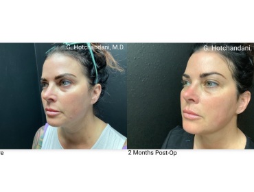 skin_rejuvenation_before_and_after-4