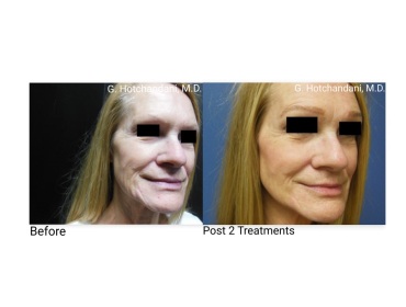 skin_rejuvenation_before_and_after-5