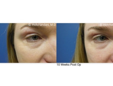 skin_rejuvenation_before_and_after-7