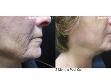 skin_rejuvenation_before_and_after-8