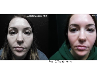 skin_rejuvenation_before_and_after-9