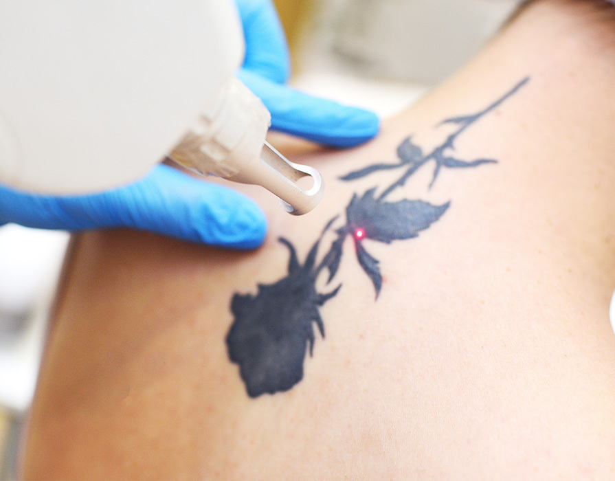 tattoo-removal