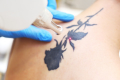 Tattoo Removal