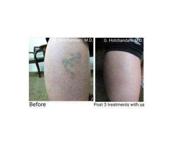 tattoo_removal_before_and_after-1