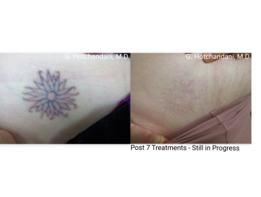 tattoo_removal_before_and_after-10