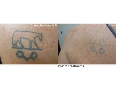 tattoo_removal_before_and_after-11