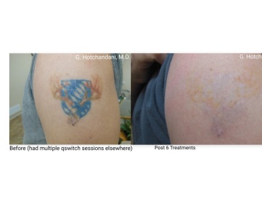 tattoo_removal_before_and_after-13