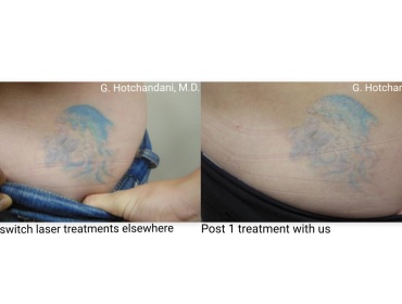 tattoo_removal_before_and_after-14