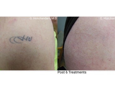 tattoo_removal_before_and_after-15