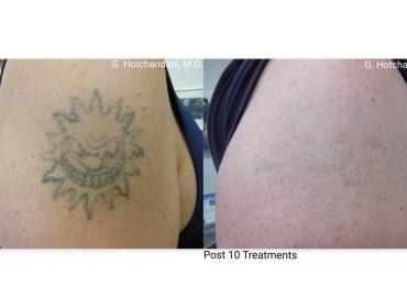 tattoo_removal_before_and_after-16
