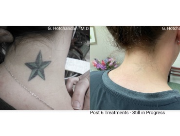 tattoo_removal_before_and_after-17