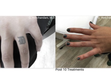 tattoo_removal_before_and_after-18